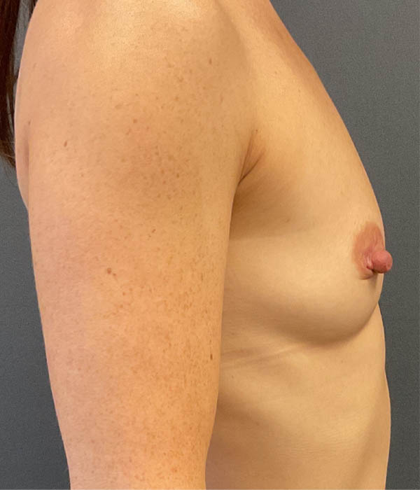 Breast Augmentation