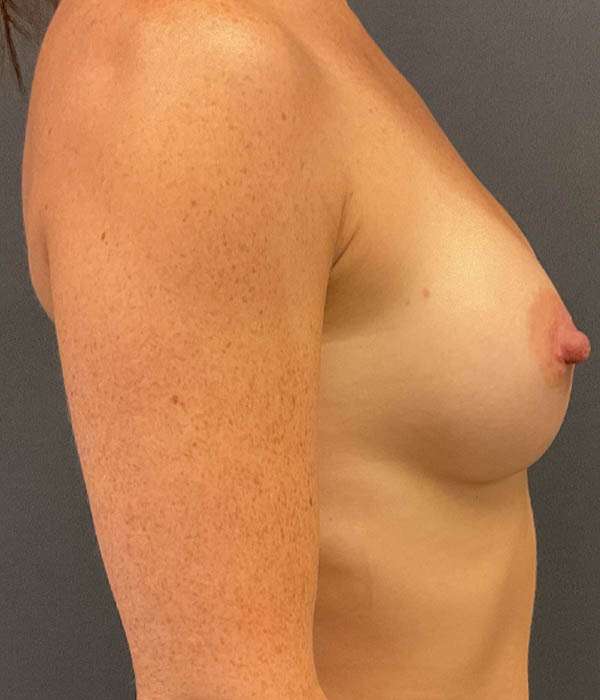 Breast Augmentation