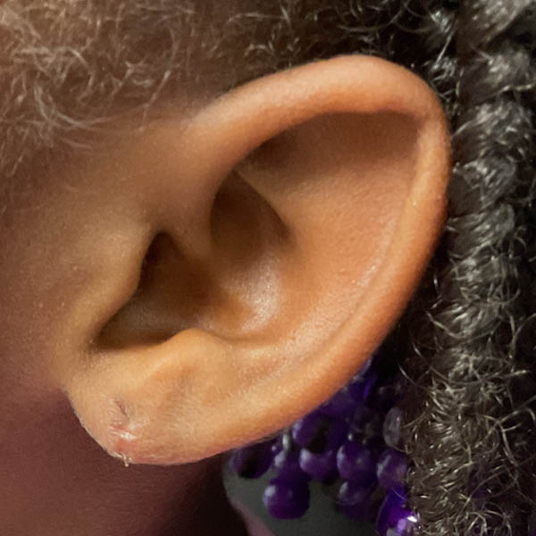 Earlobe Repair