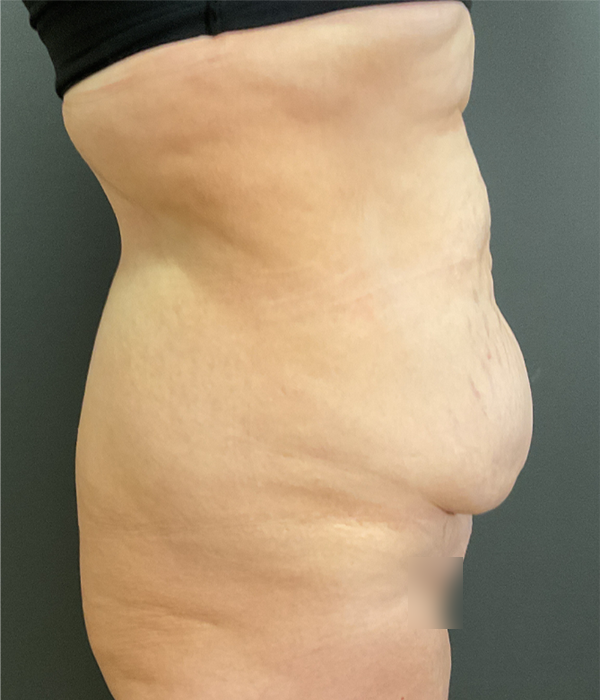Tummy Tuck