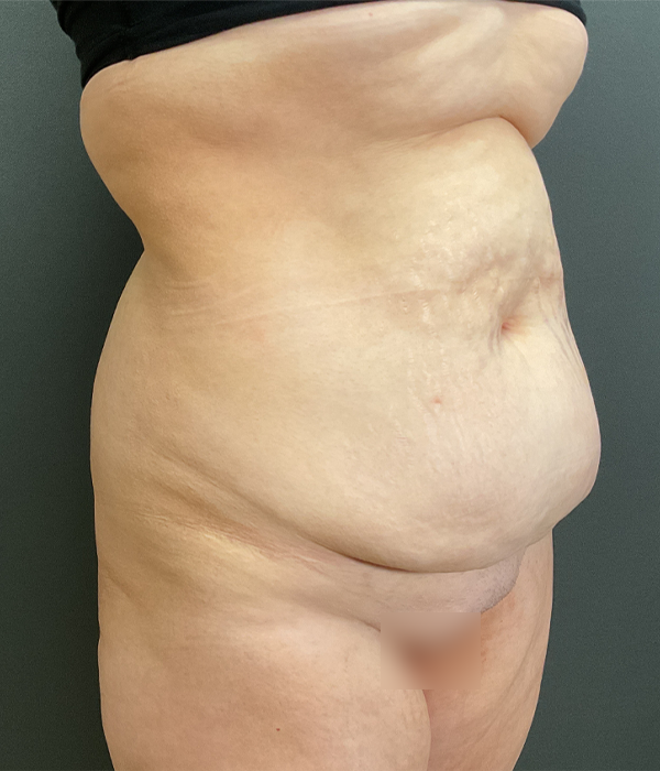 Tummy Tuck