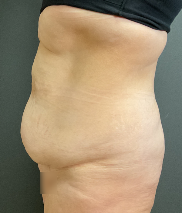 Tummy Tuck