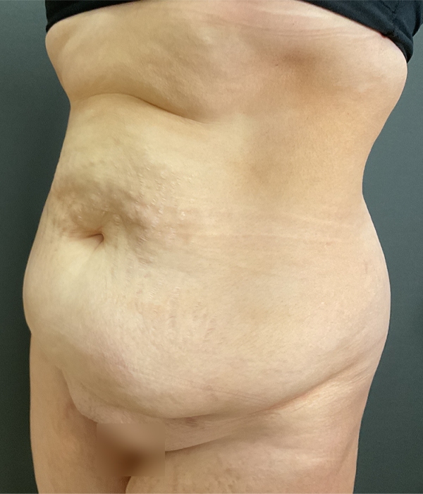 Tummy Tuck