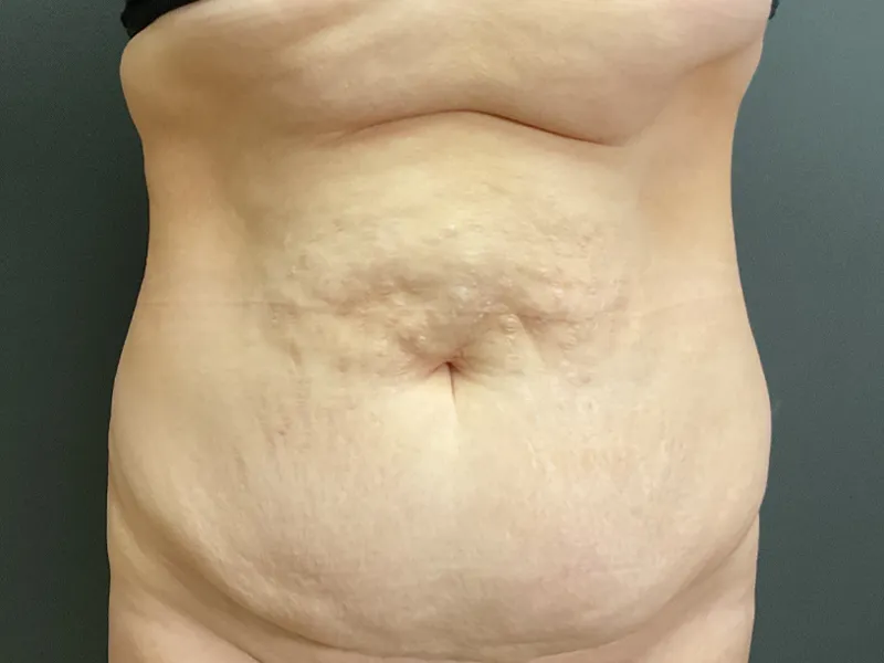 Tummy Tuck