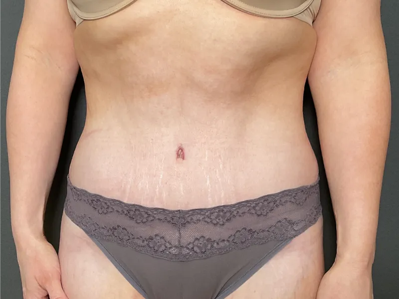 Tummy Tuck
