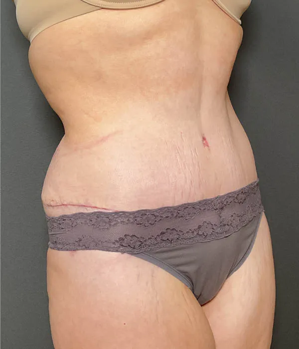 Tummy Tuck