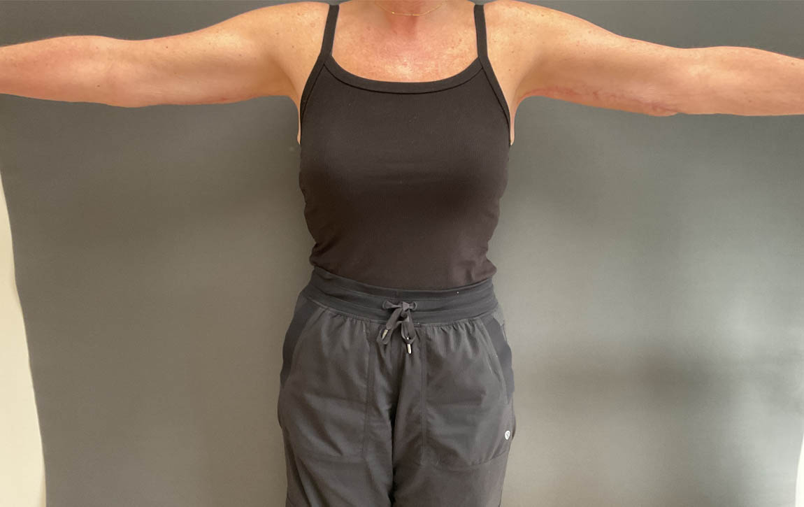 Arm Lift