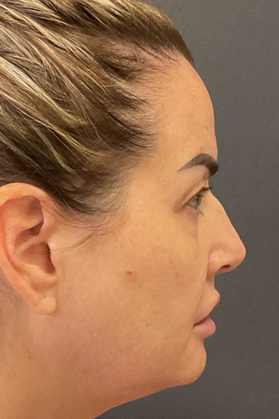 Blepharoplasty