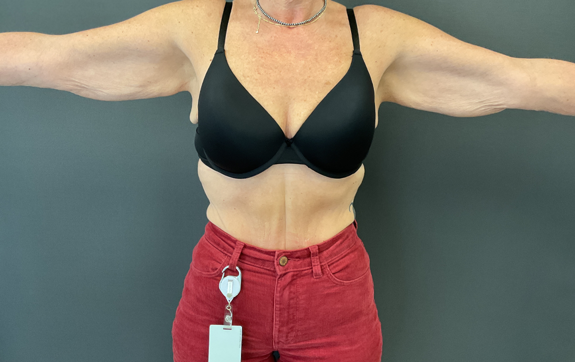 Arm Lift