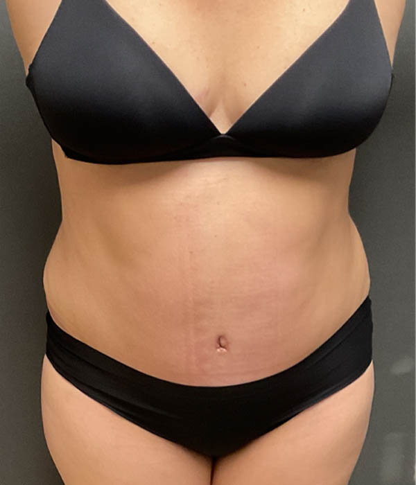 Liposuction