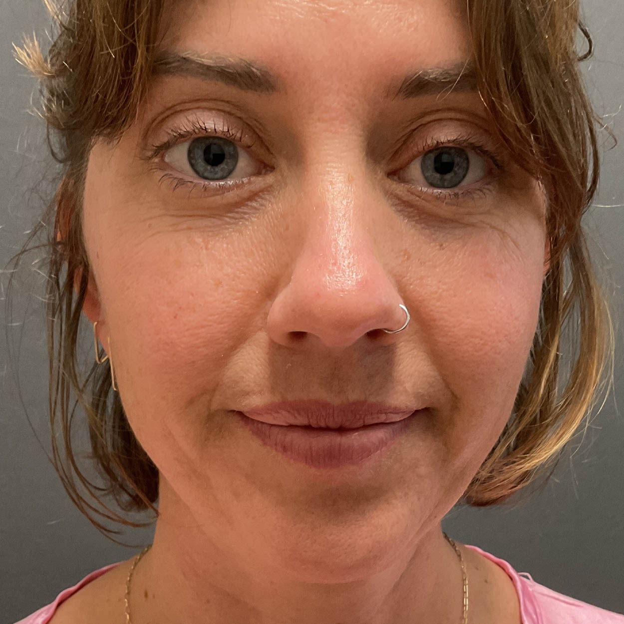 Chin Augmentation
