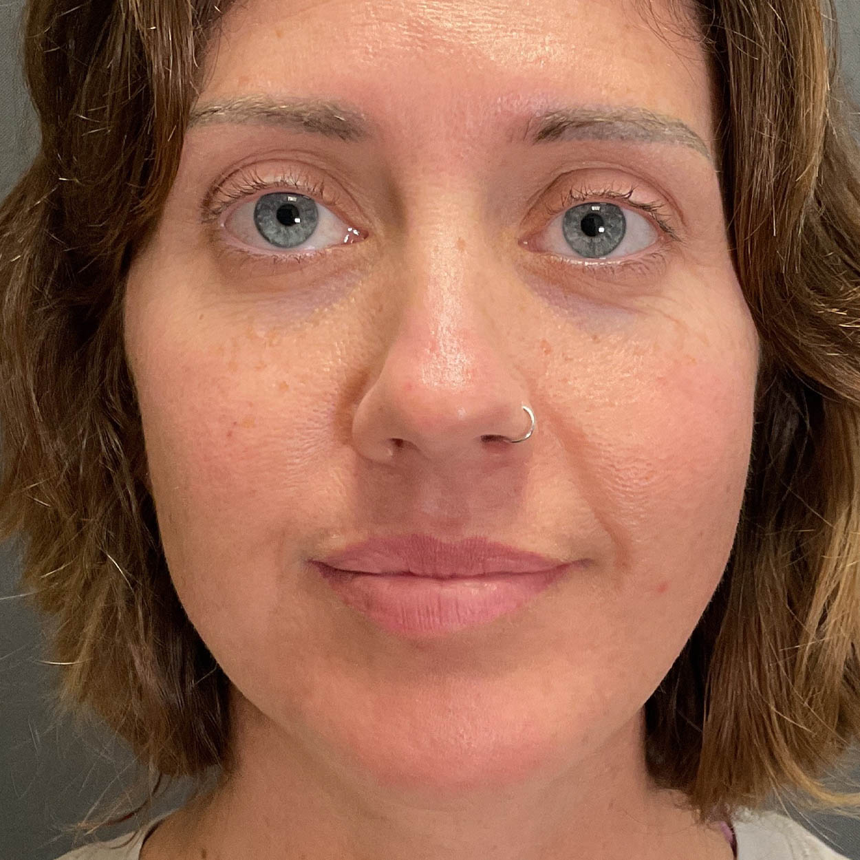 Chin Augmentation