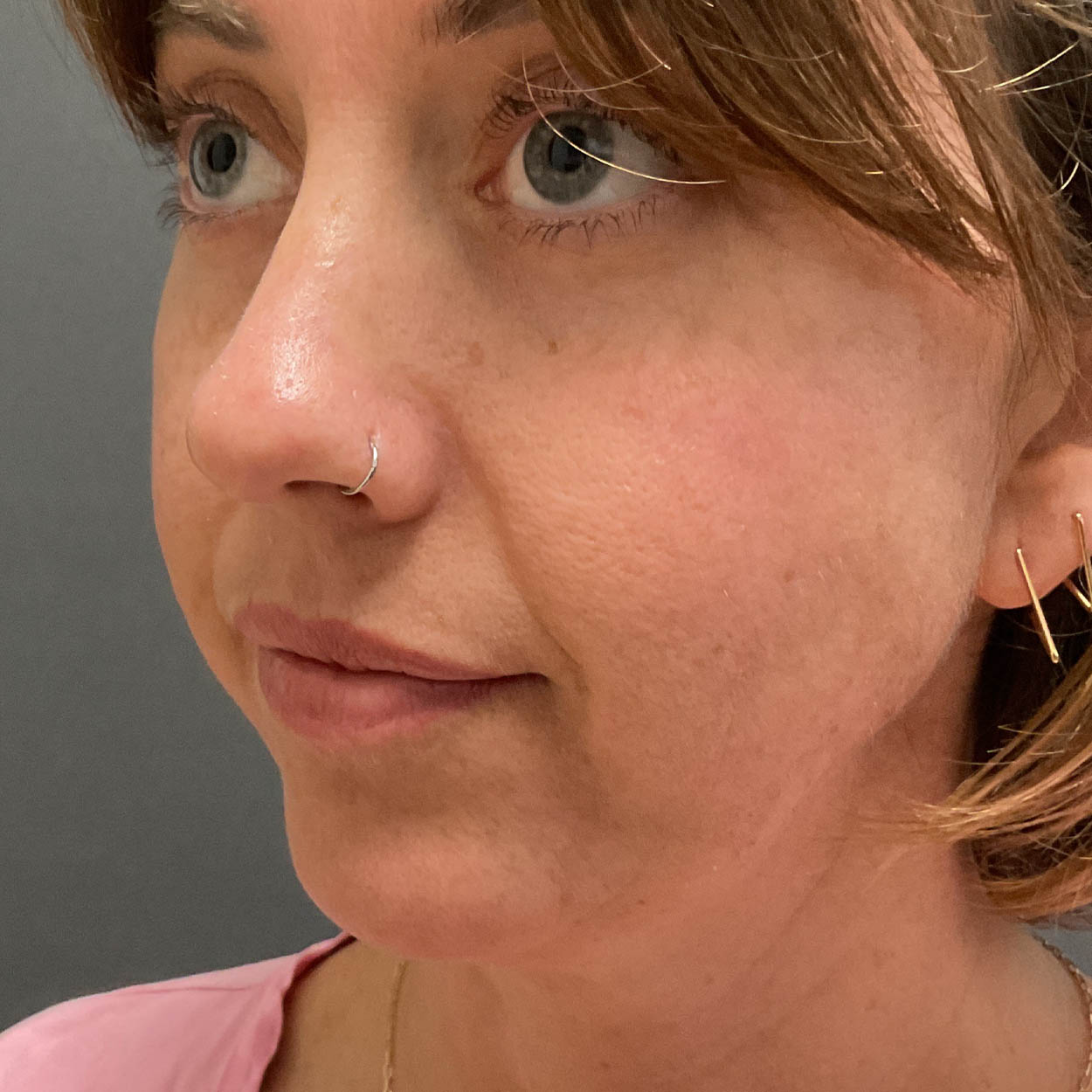 Chin Augmentation