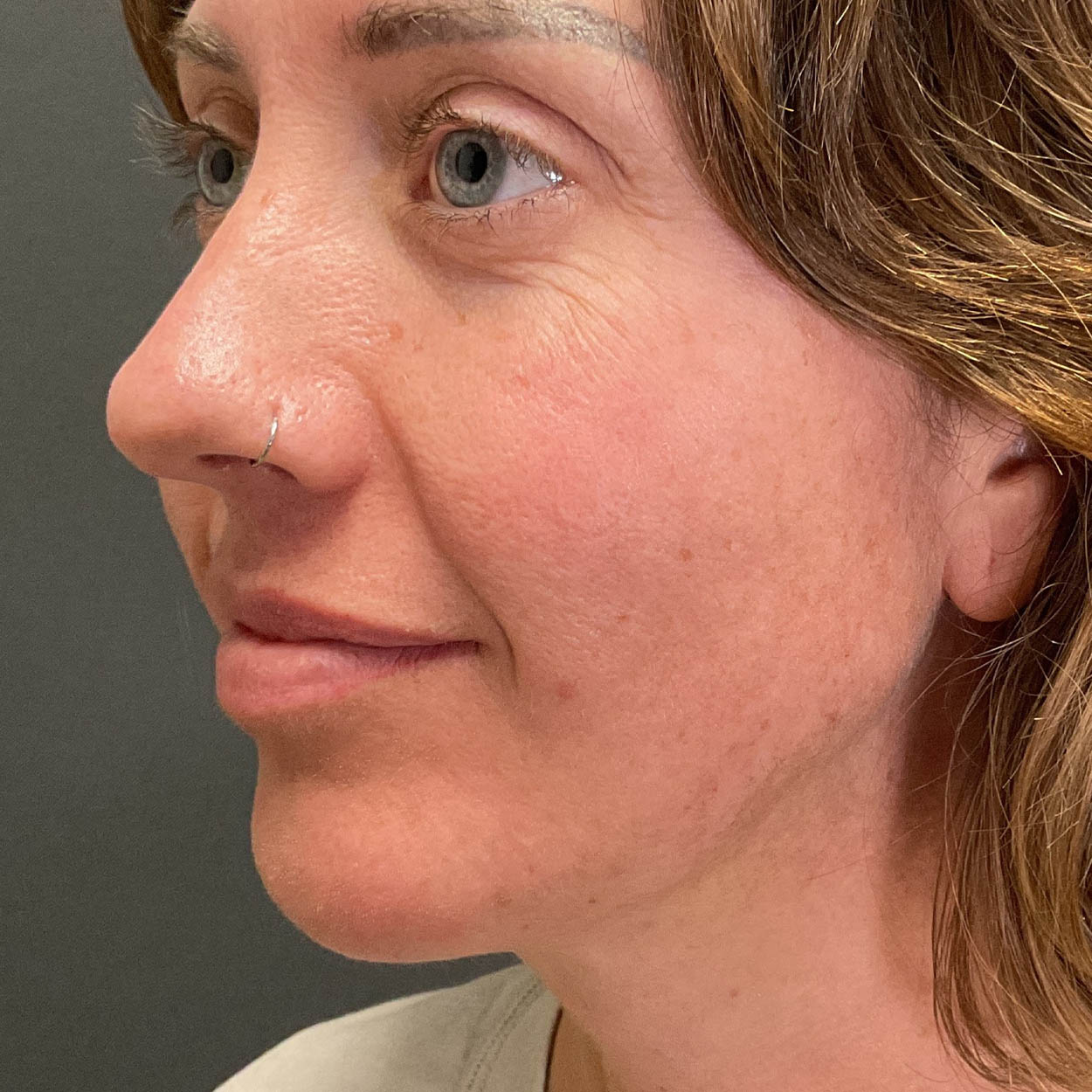 Chin Augmentation