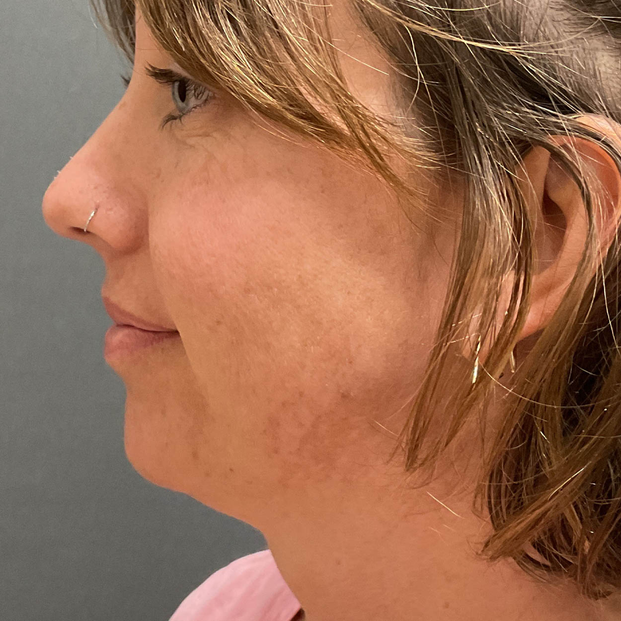 Chin Augmentation