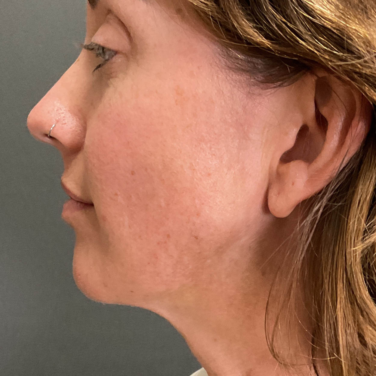 Chin Augmentation