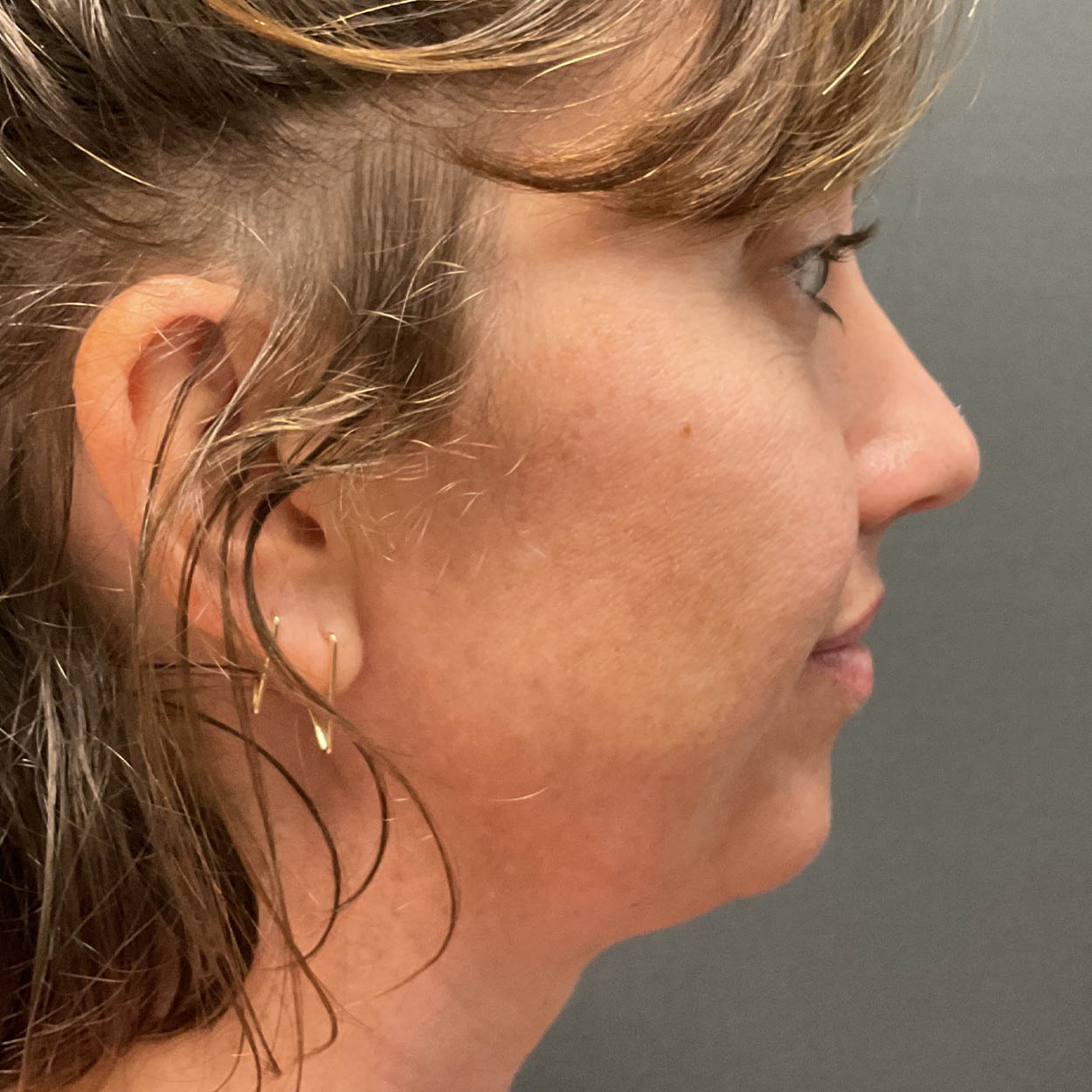 Chin Augmentation