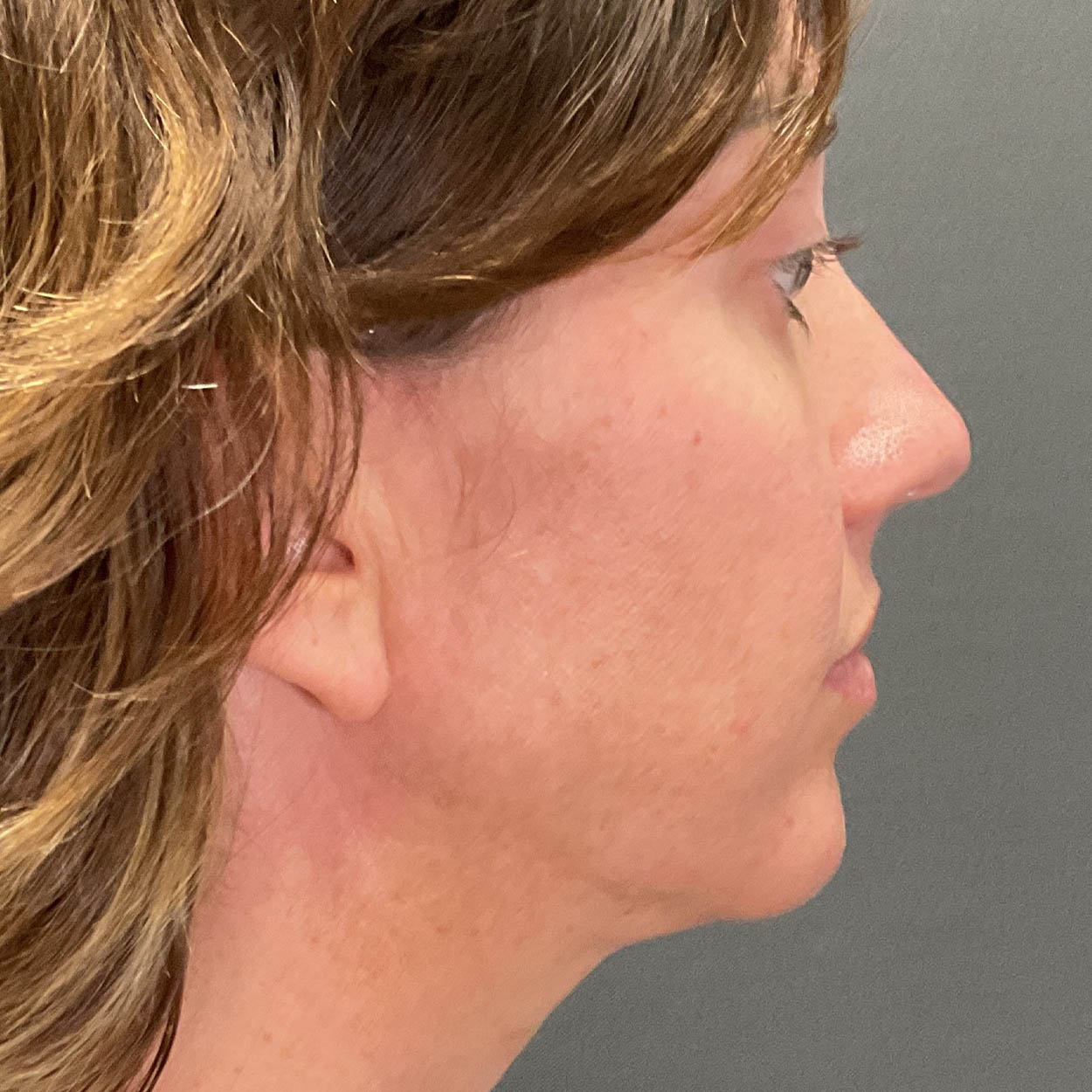 Chin Augmentation