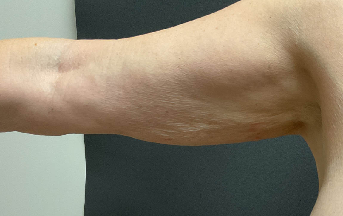 Arm Lift