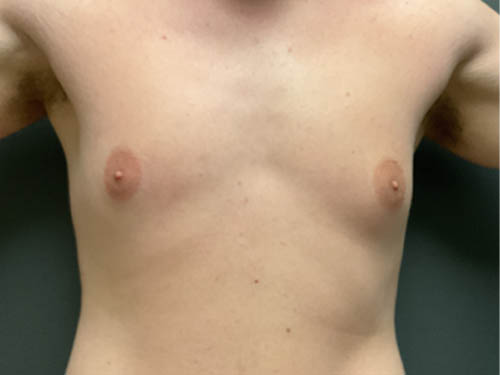 Gynecomastia