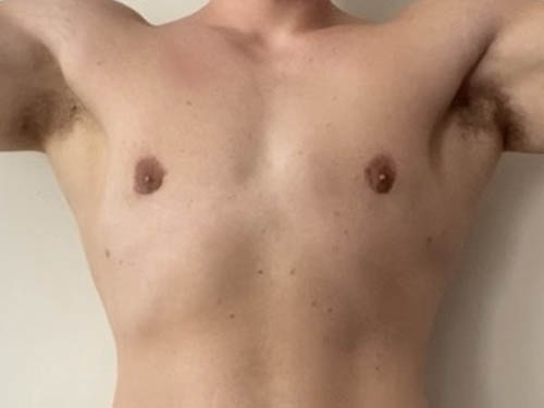Gynecomastia