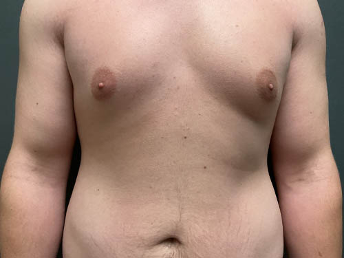 Gynecomastia