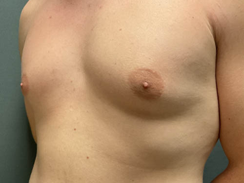 Gynecomastia
