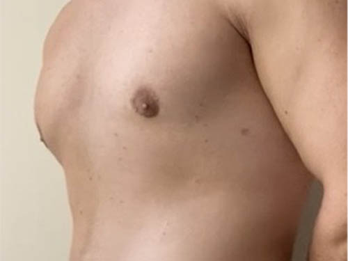 Gynecomastia
