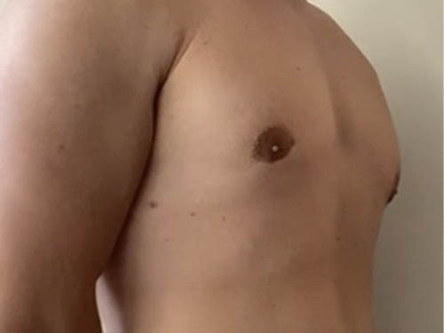 Gynecomastia