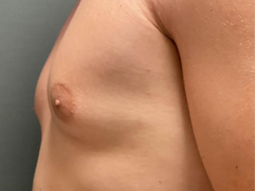 Gynecomastia