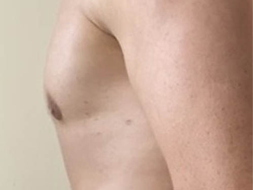 Gynecomastia