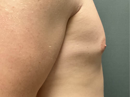 Gynecomastia