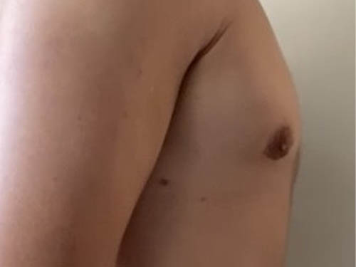 Gynecomastia
