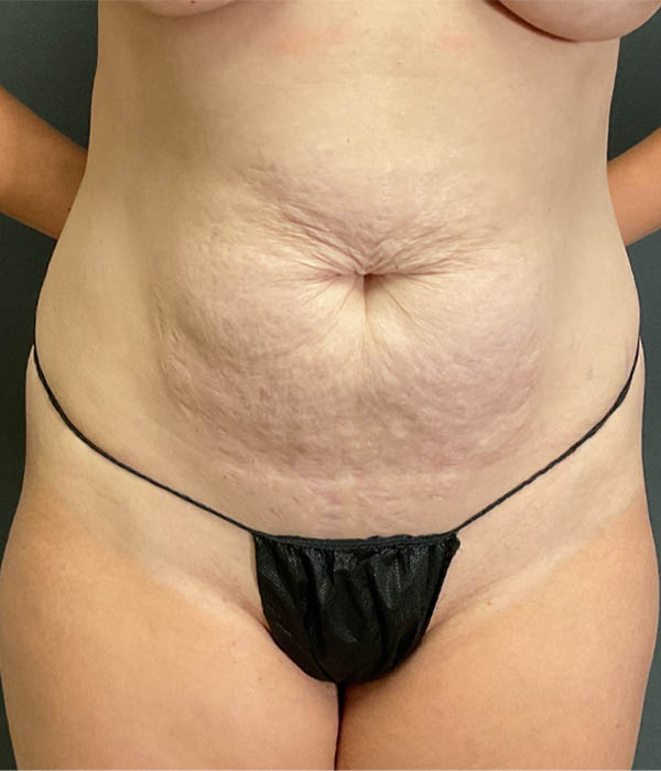 Tummy Tuck