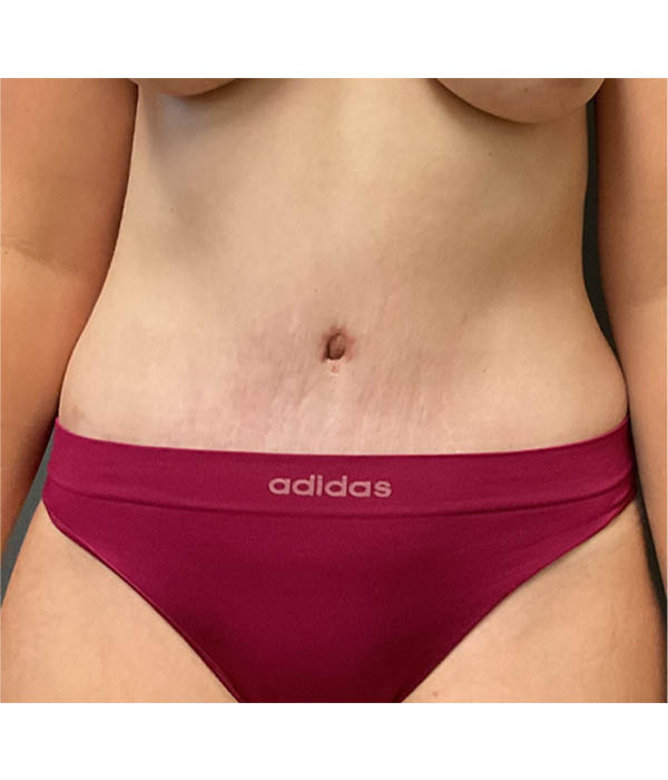 Tummy Tuck
