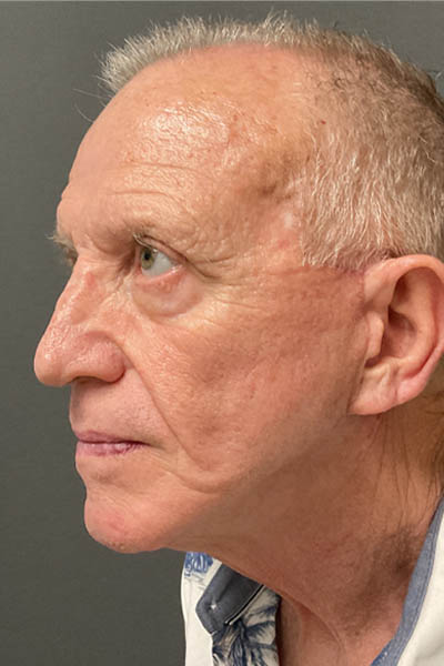 Facelift