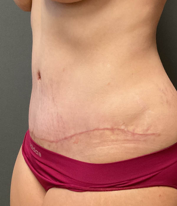 Tummy Tuck