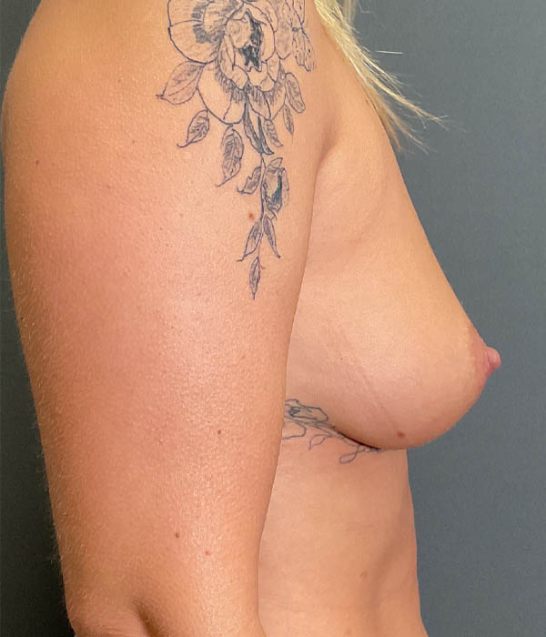 Breast Augmentation