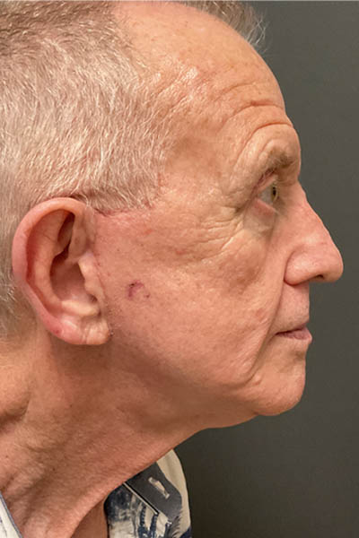 Facelift