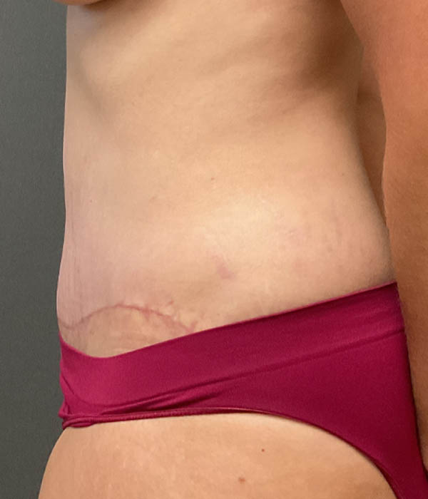 Tummy Tuck