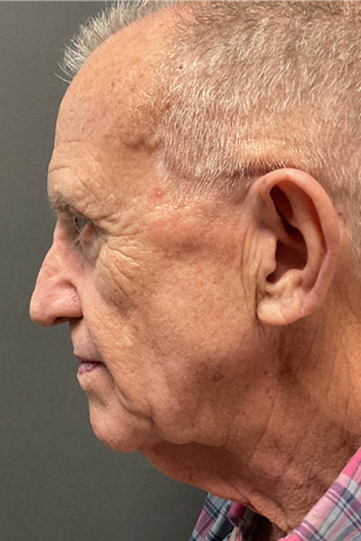 Facelift