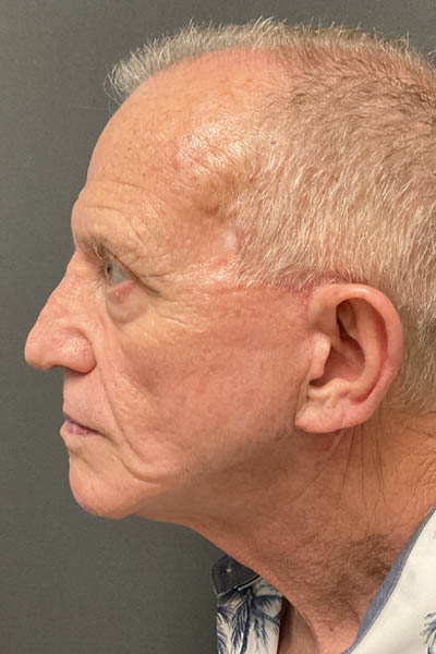 Facelift