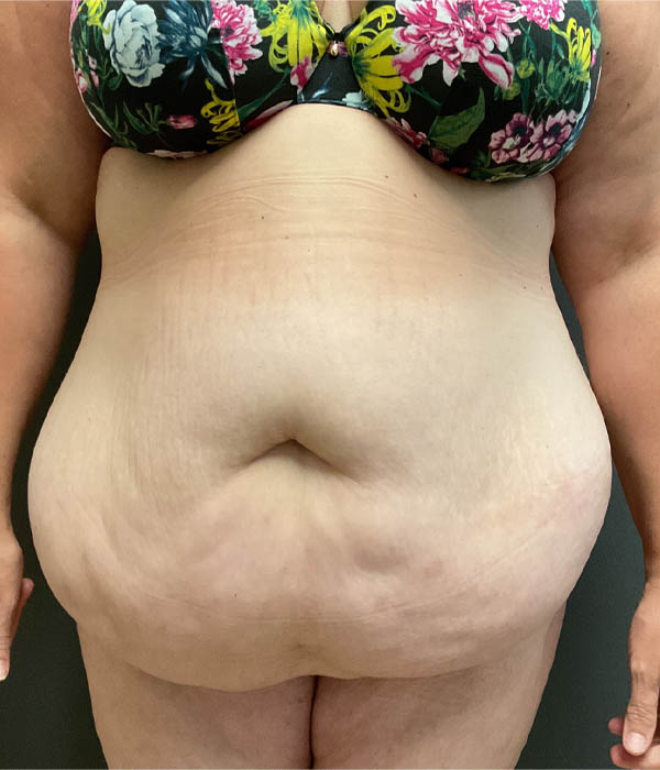 Tummy Tuck