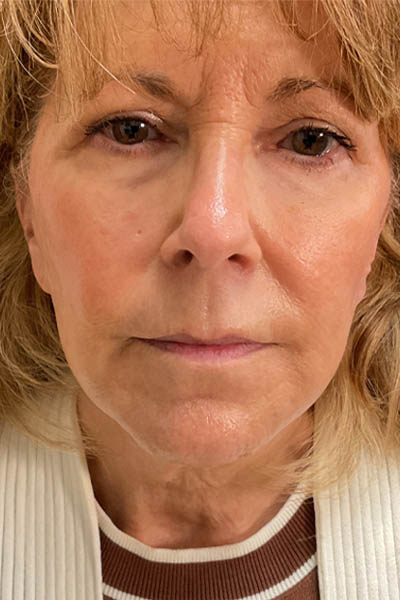 Awake Facelift