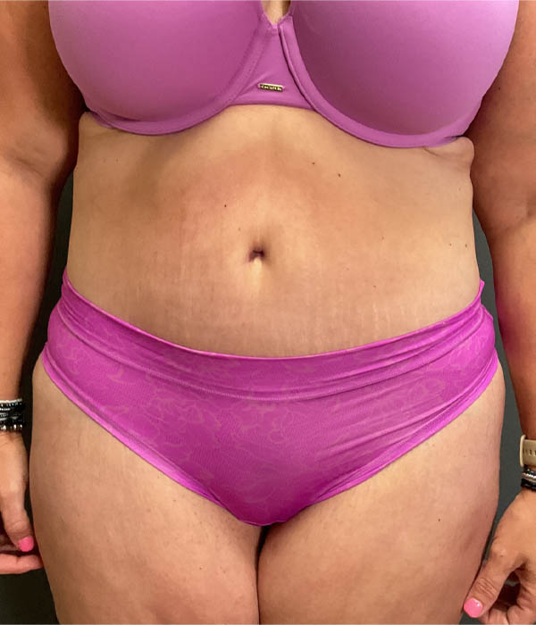 Tummy Tuck