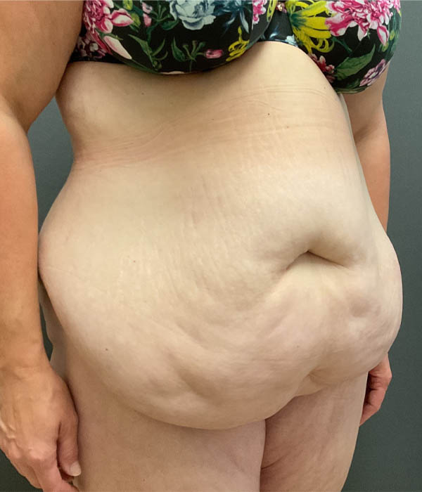 Tummy Tuck