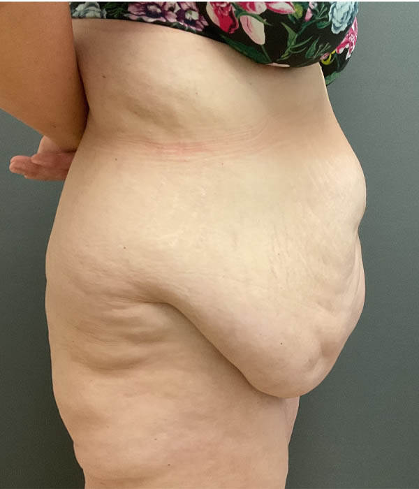 Tummy Tuck