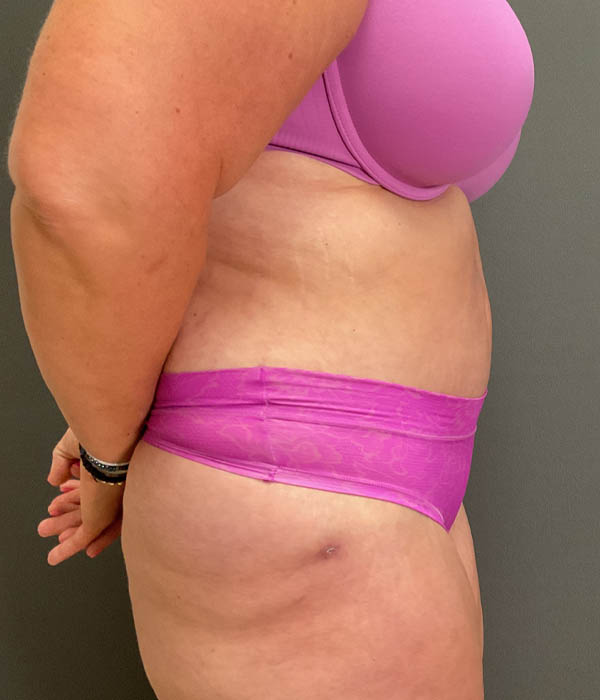 Tummy Tuck