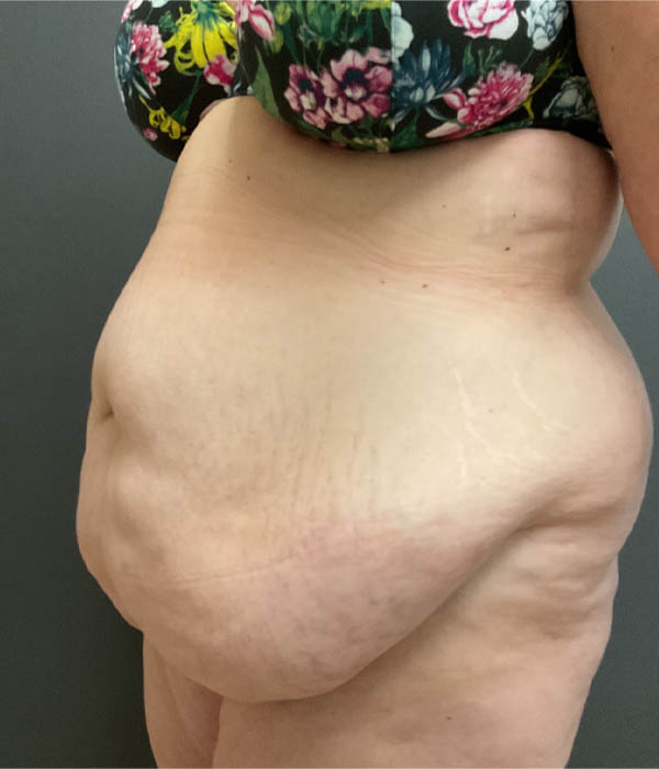 Tummy Tuck