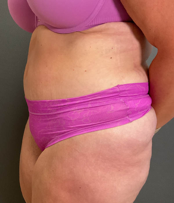 Tummy Tuck
